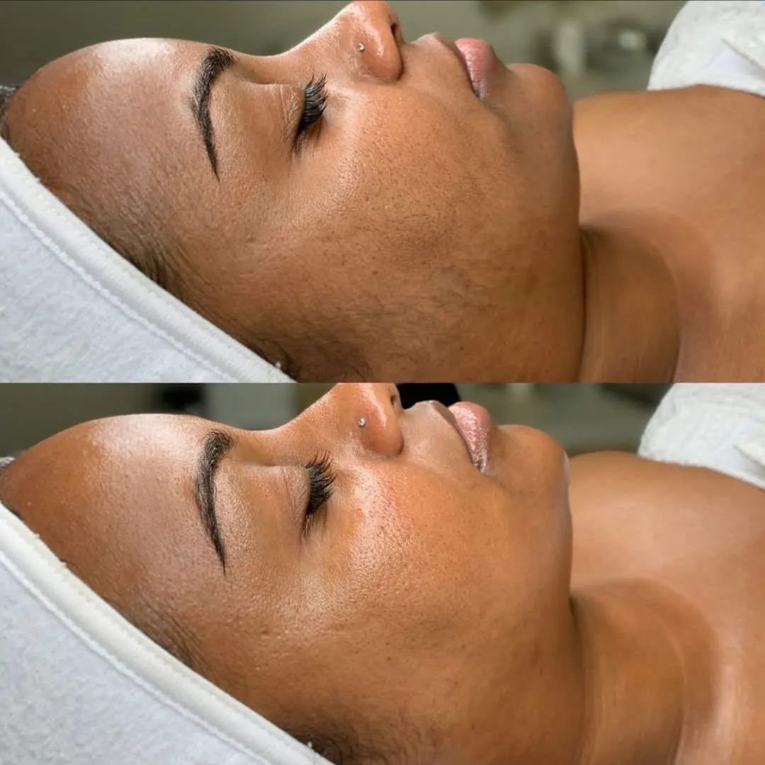 Sessão de dermaplaning removendo pelos faciais em Uberlândia