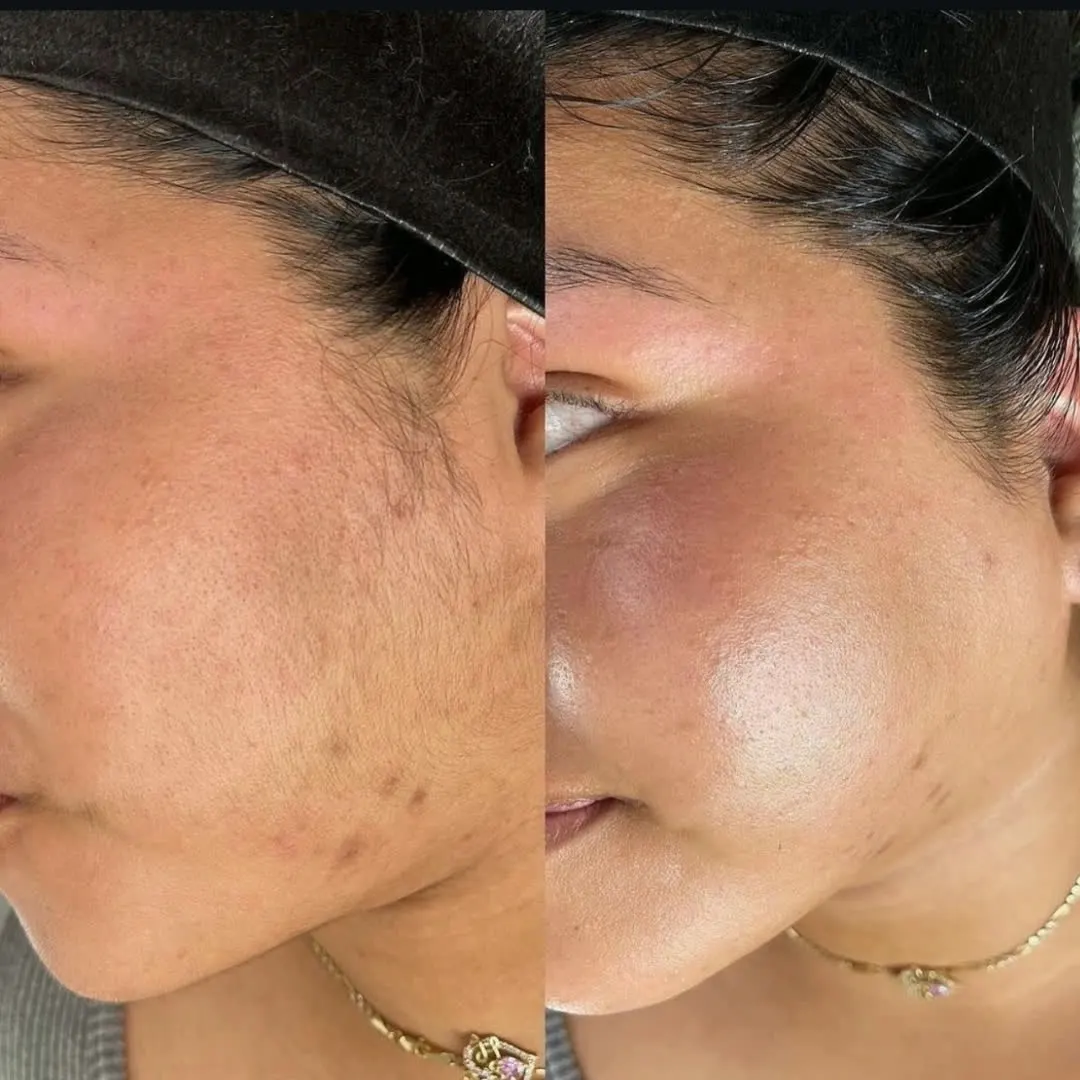 Pele mais suave e luminosa após dermaplaning