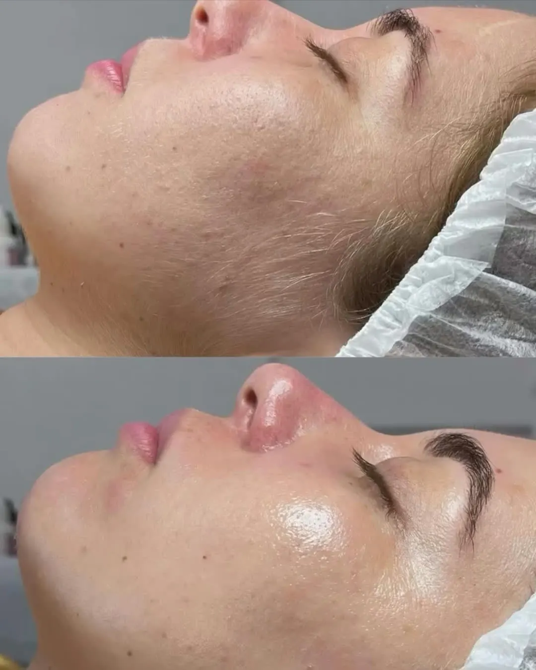 Resultado imediato de dermaplaning facial