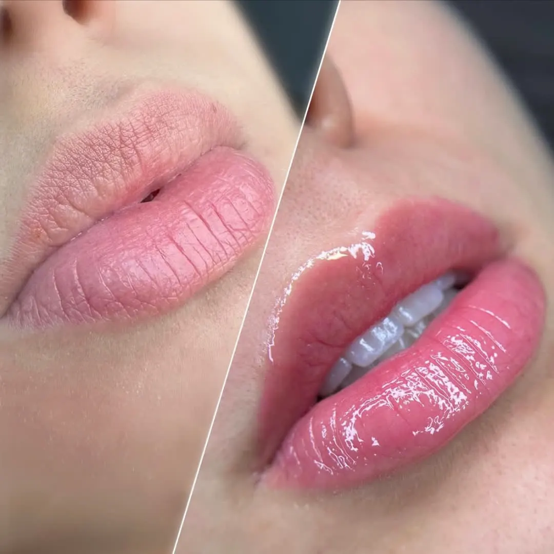 Resultado de tratamento Hidra Gloss